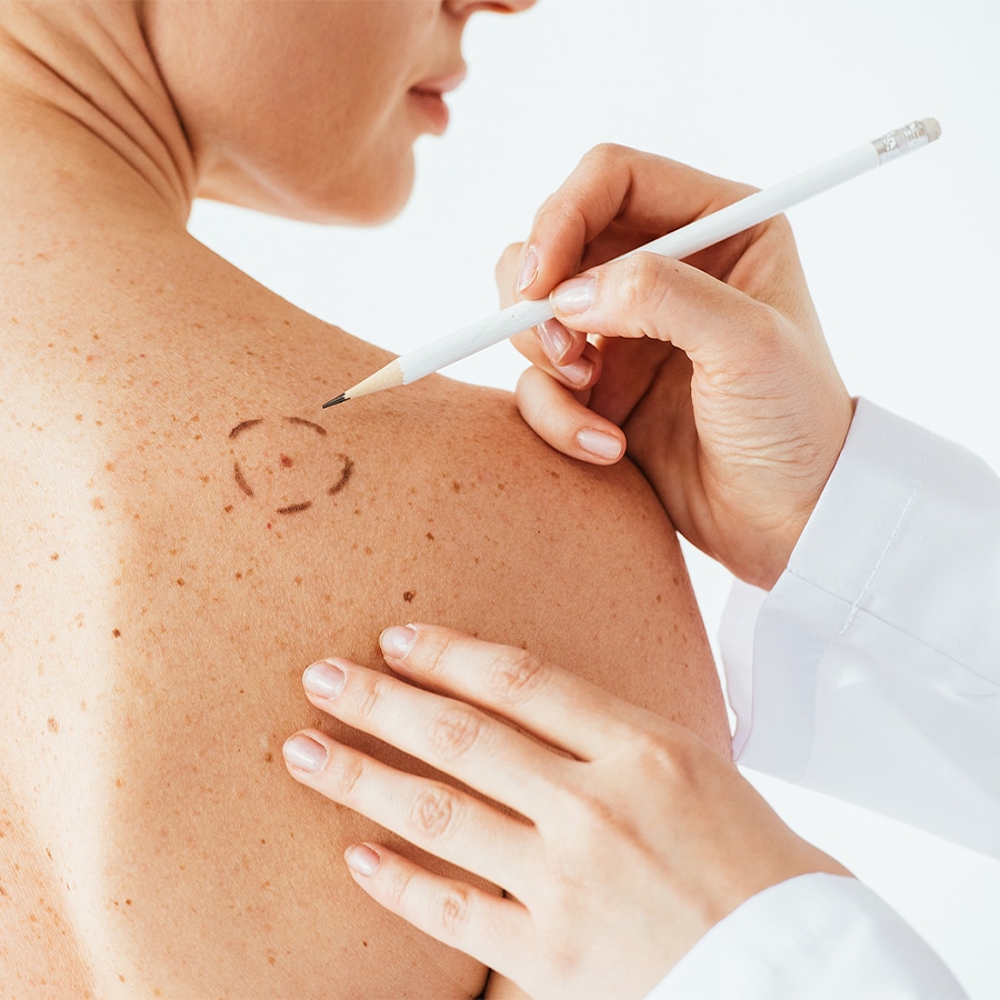 dermatology doctor drawing a circle on a white woman's shoulder